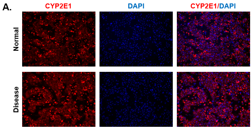 CYP2E1 Expression in Normal and Diseased PHHs. (A) Staining for CYP2E1 (red) expression and DAPI (Blue) with the merged image shown (blue and red) on day 15. 