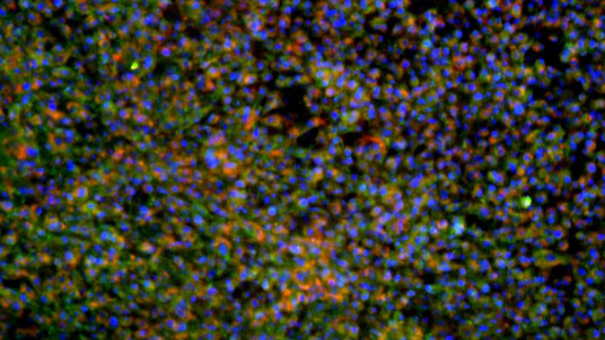 iPSC-derived hepatocytes on HuGentraTM stained with albumin and alpha-fetoprotein